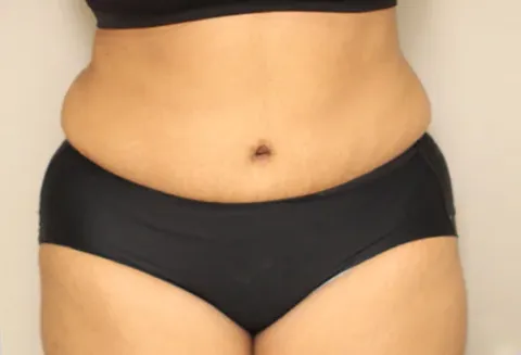 Post Operative Result