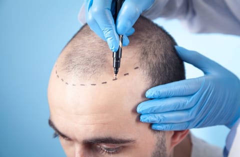 Hair transplant consultation at Cosmetiq Hospital