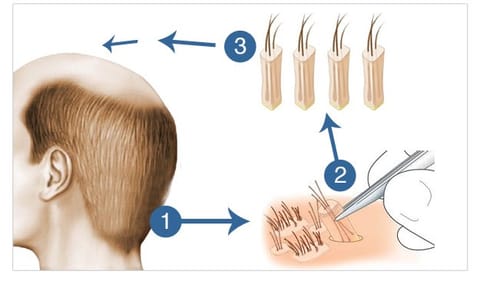 FUE Hair Transplant Technique