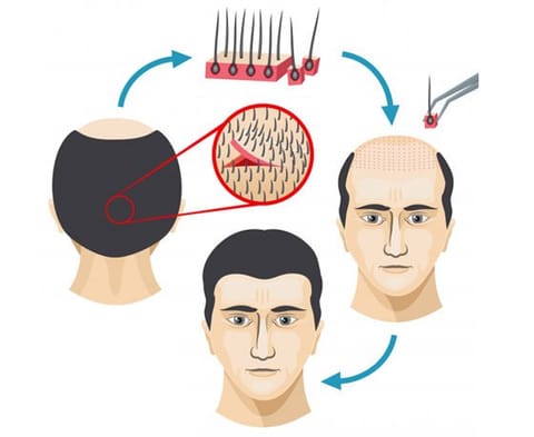 FUT Strip Hair Transplant