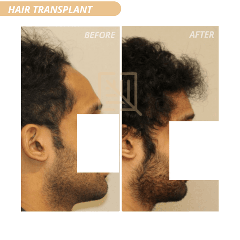 Hair transplant result at Cosmetiq Hospital